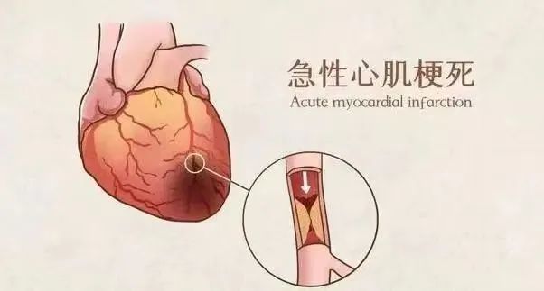 【保山安利醫(yī)院】11月20日“心梗救治日” 時(shí)間就是心肌，時(shí)間就是生命！
